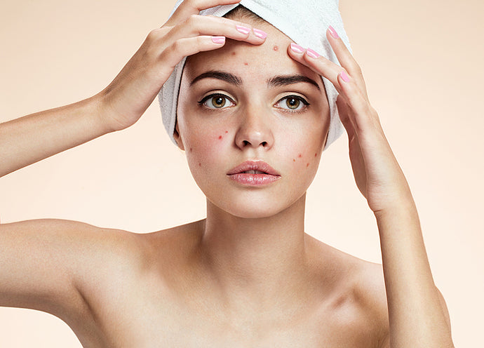 Skinspiration… Could your skincare be creating your acne?